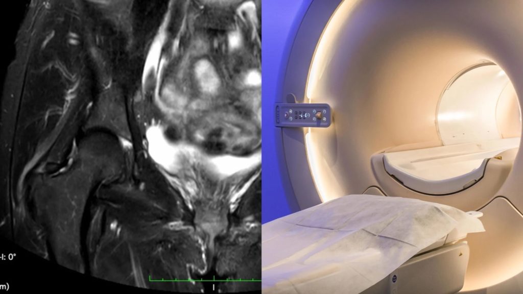 Photo d'une IRM pour analyser les tissus de la hanche en cas de tendinopathie