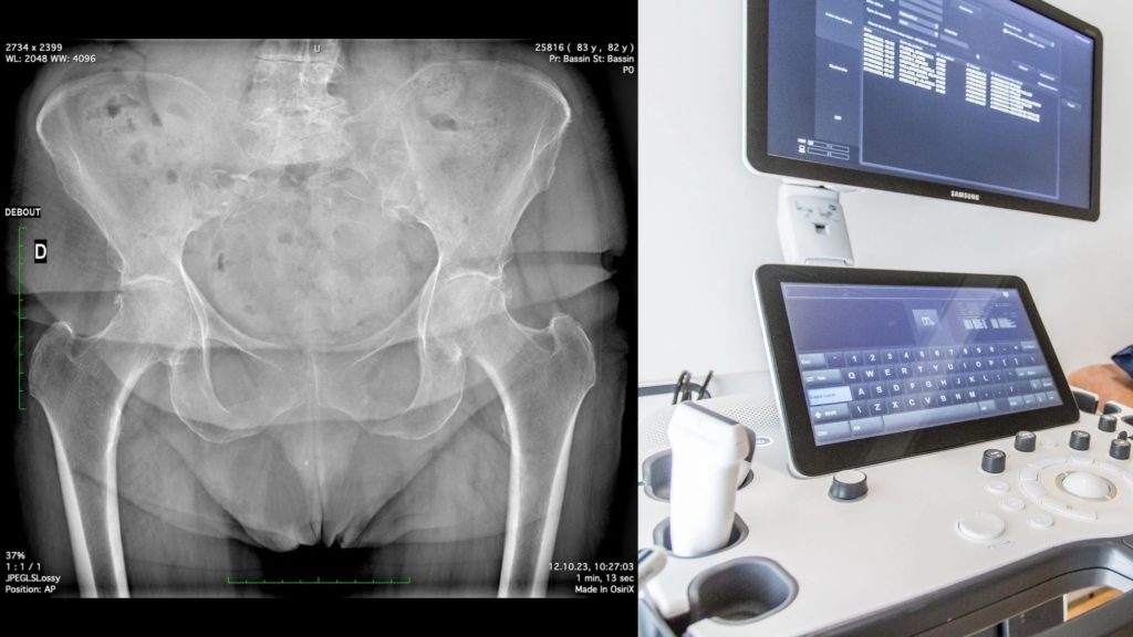 Imagerie médicale d'une tendinopathie du moyen fessier