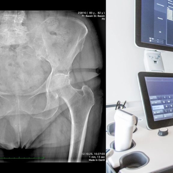 Le rôle de l’imagerie dans la prise en charge des tendinopathies du moyen fessier