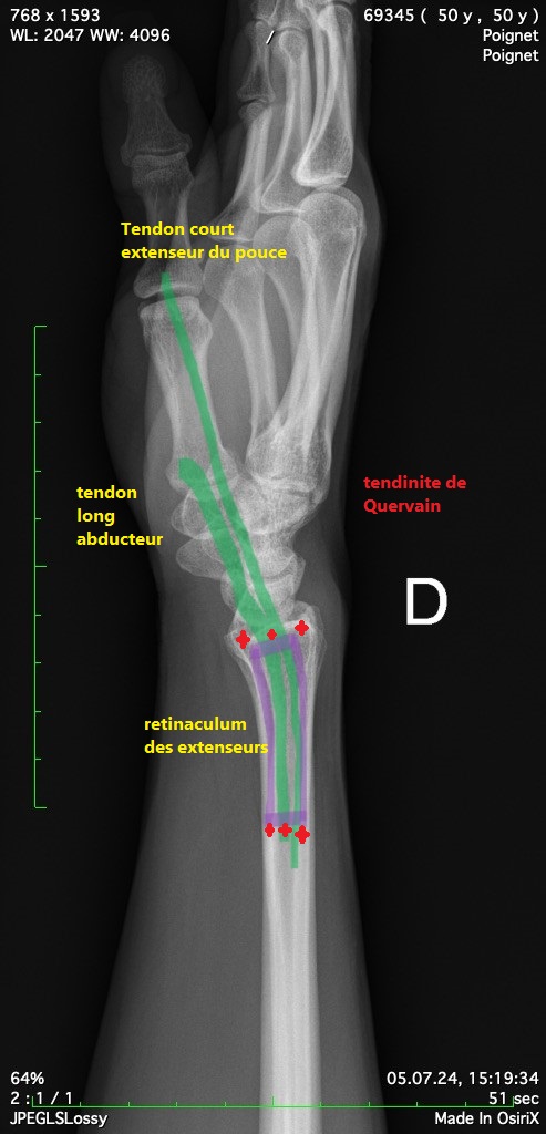 Image radiographique d'un poignet présentant une tendinite de De Quervain.